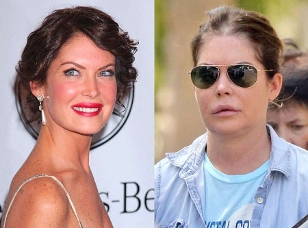 A picture of lara Flynn Boyle before (left) and after (right).